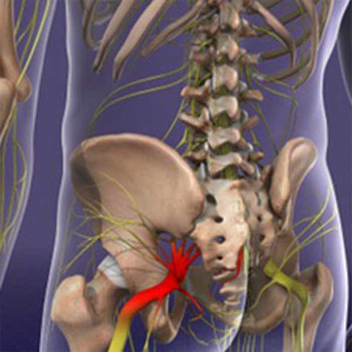 Chiropractic care for sciatica in Roseville
