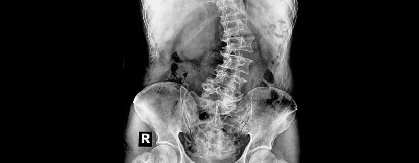 Patient needing Scoliosis treatment in Roseville