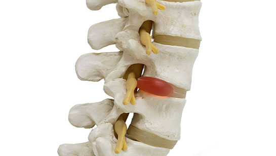 Herinated disc relief from chiropractic in Roseville