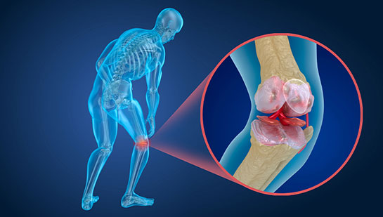 Osteoporosis treatment in Roseville