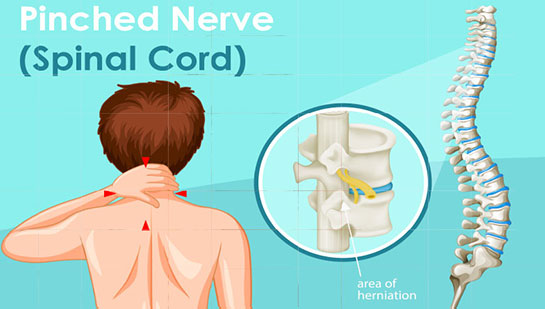 Chiropractic for pinched nerve pain relief in Roseville
